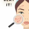 Acne, Beat It!