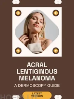 Acral Lentiginous Melanoma