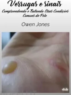 Verrugas E Sinais